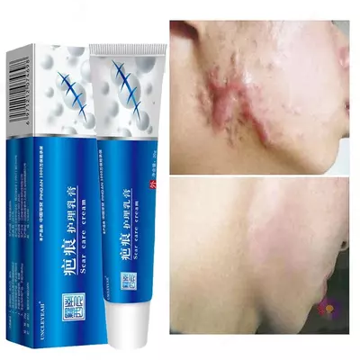 Крем от шрамов и прыщей Sear care cream