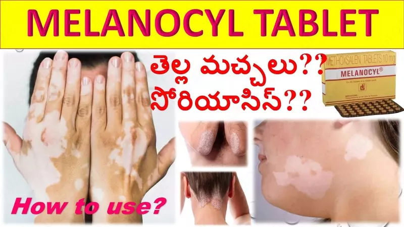 Vitiligo uchun melanocyl (Melanocyl) tabletkalari