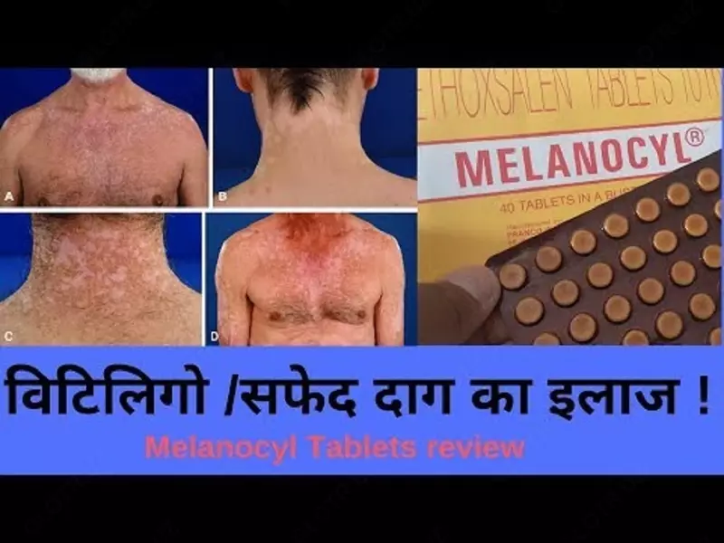 Vitiligo uchun melanocyl (Melanocyl) tabletkalari
