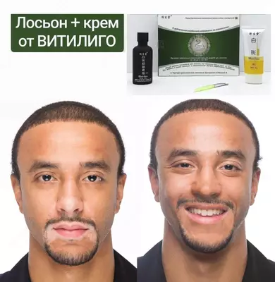 Набор Змея - Комплекс специальных средств для лечения витилиго