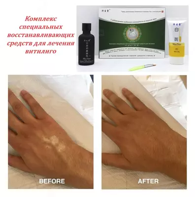 Набор Змея - Комплекс специальных средств для лечения витилиго