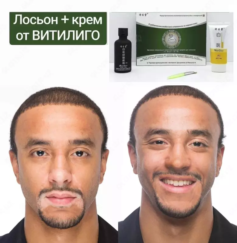 Набор Змея - Комплекс специальных средств для лечения витилиго