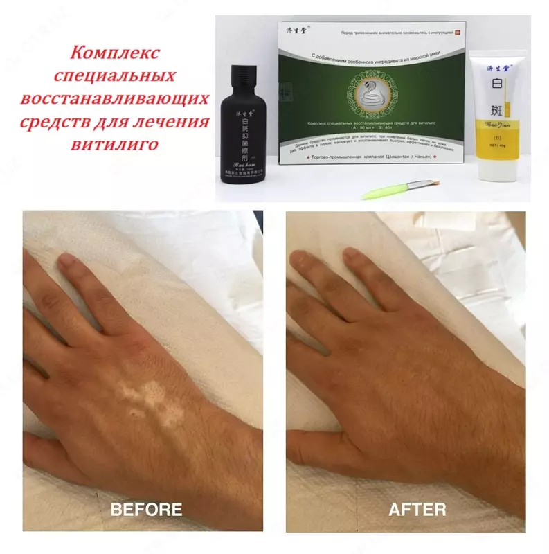 Набор Змея - Комплекс специальных средств для лечения витилиго