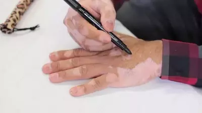 Vitiligo flamaster Xishengyan (marker)