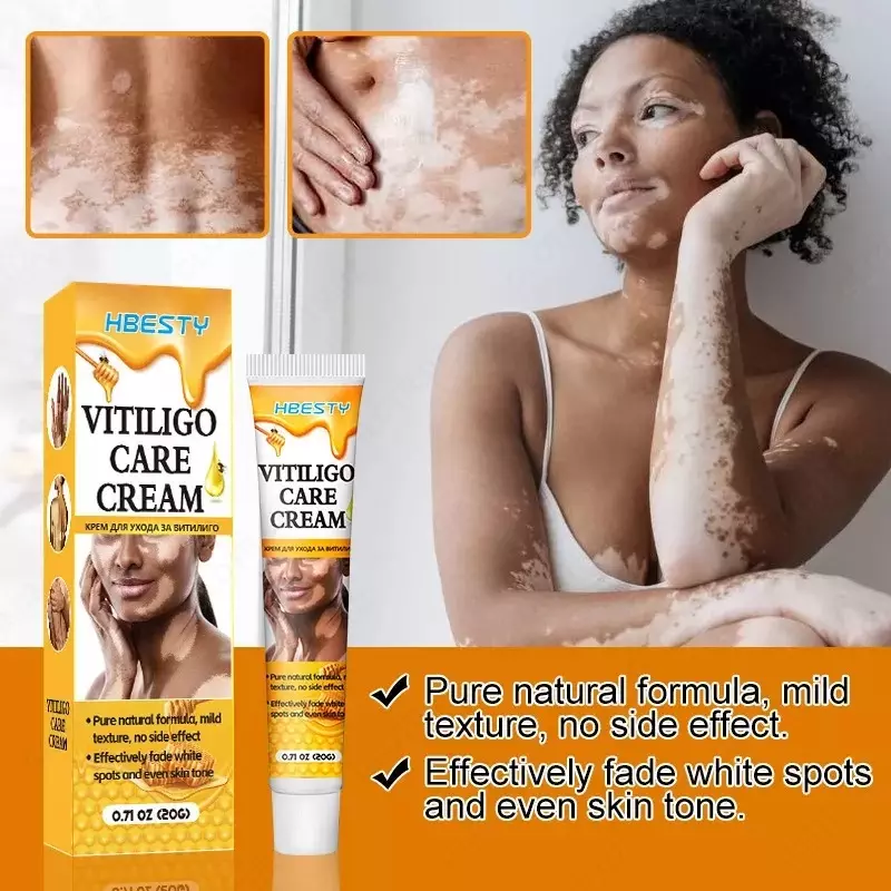Крем от витилиго Vitiligo Care Crem HBESTY