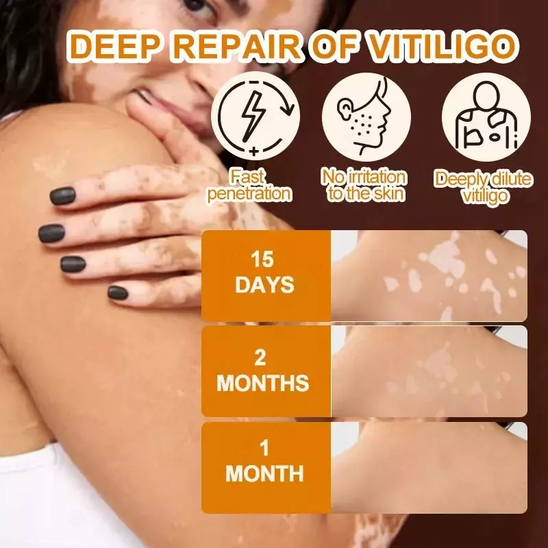 Vitiligo kremi Vitiligo Care Cream HBESTY