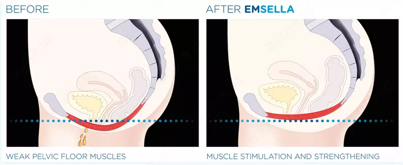 BTL Emsella - ayollar va erkaklar uchun tos bo'shlig'i salomatligi uchun yechim! - BTL Medical Technologies