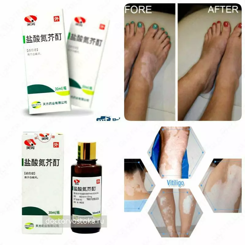 Лосьон для лечения витилиго