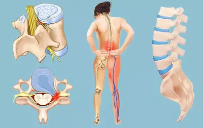 Xalqaro standart usuli bo'yicha 12-60 yoshdagi bolalar va kattalardagi skoliozni kompleks davolash-Katarina shrot