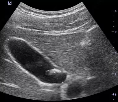 Кабинет ультразвуковой диагностики / УЗИ печени и желчного пузыря - 80 000 сум