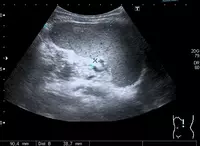 Кабинет ультразвуковой диагностики / УЗИ селезенки - 70 000 сум