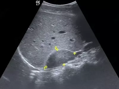 надпочечники