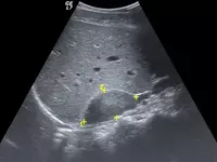 надпочечники