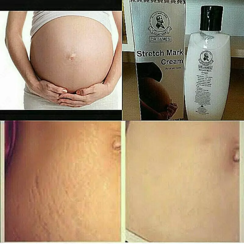 100 000 сум Крем от растяжек Доктор Джеймс Dr. James Stretch Mark Cream (200 мл)