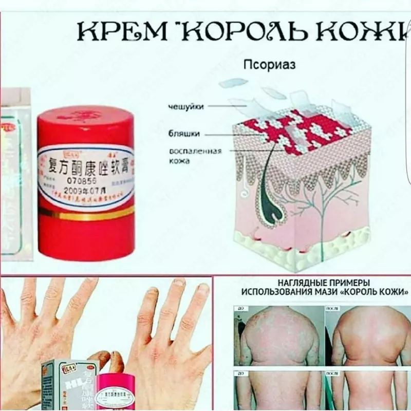 65 000 so'm "Teri qiroli" toshbaqa kasalligi uchun Tailand malhami