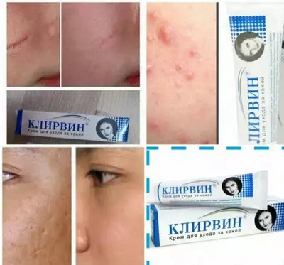 Крем "Клирвин" от шрамов и пятен - 65 000 сум / шт.