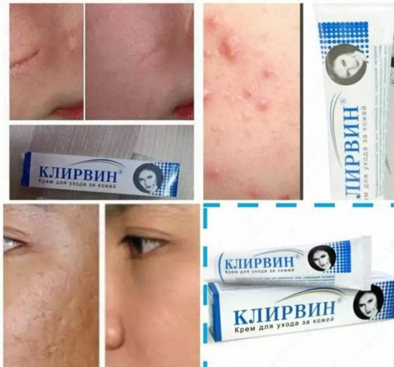Крем "Клирвин" от шрамов и пятен - 65 000 сум