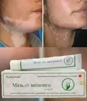 79 000 so'm Vitiligo malhami Huayaaotan