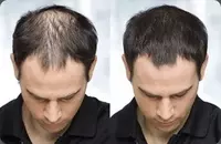 Toppik sochni qalinlashtiruvchi kukun Chakana savdo