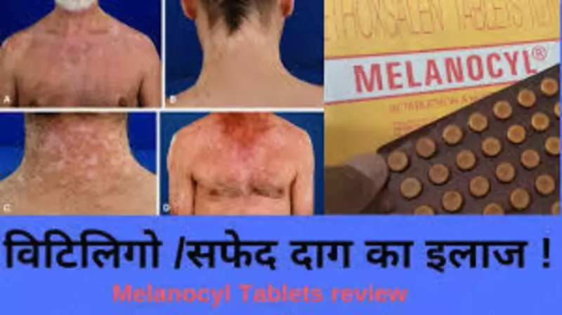 69 000 so'm Tabletkalar Melanocil (Melanocyl) vitiligo uchun