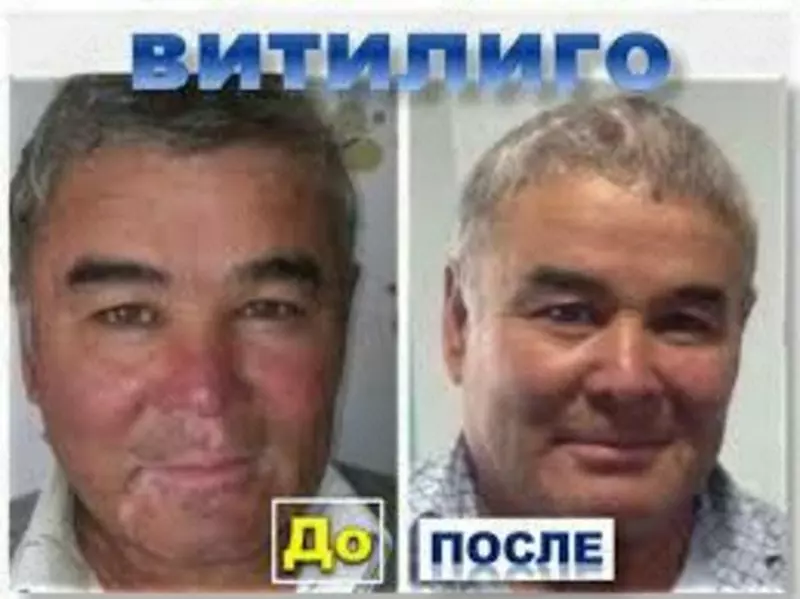  Настойка хлорметин гидрохлорида для лечения витилиго - 