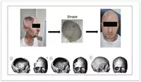 Изготовление индивидуальных Zd-имплантатов для пациентов с дефектами черепа