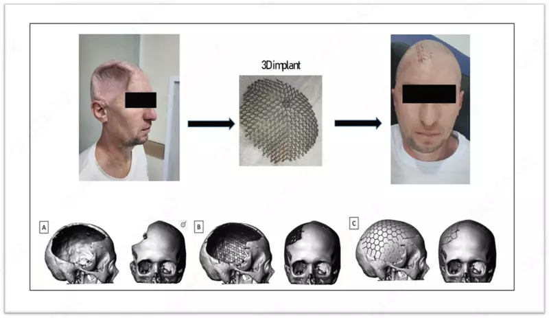 Изготовление индивидуальных Zd-имплантатов для пациентов с дефектами черепа