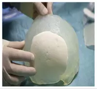  Изготовление индивидуальных Zd-имплантатов для пациентов с дефектами черепа - 