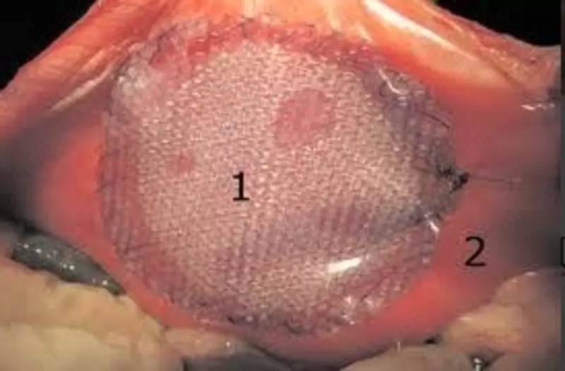 Нипроцел (Niprocel)