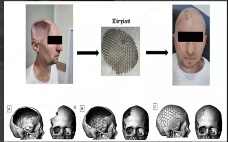 Производство индивидуальных 3D-имплантатов для пациентов с дефектами черепа - 6 290 000 сум