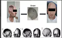 Производство индивидуальных 3D-имплантатов для пациентов с дефектами черепа - 6 290 000 сум