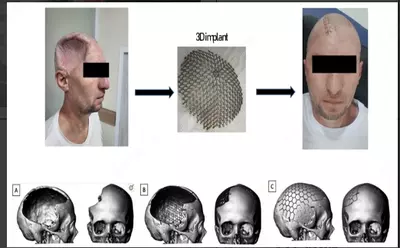 Производство индивидуальных 3D-имплантатов для пациентов с дефектами черепа - 6 290 000 so'm / dona