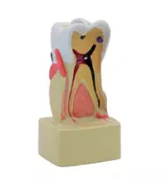 Анатомическая модель "человеческий зуб с кариесом"