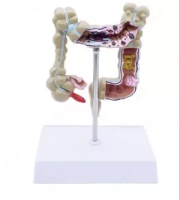 Анатомическая модель "патологии толстой кишки"