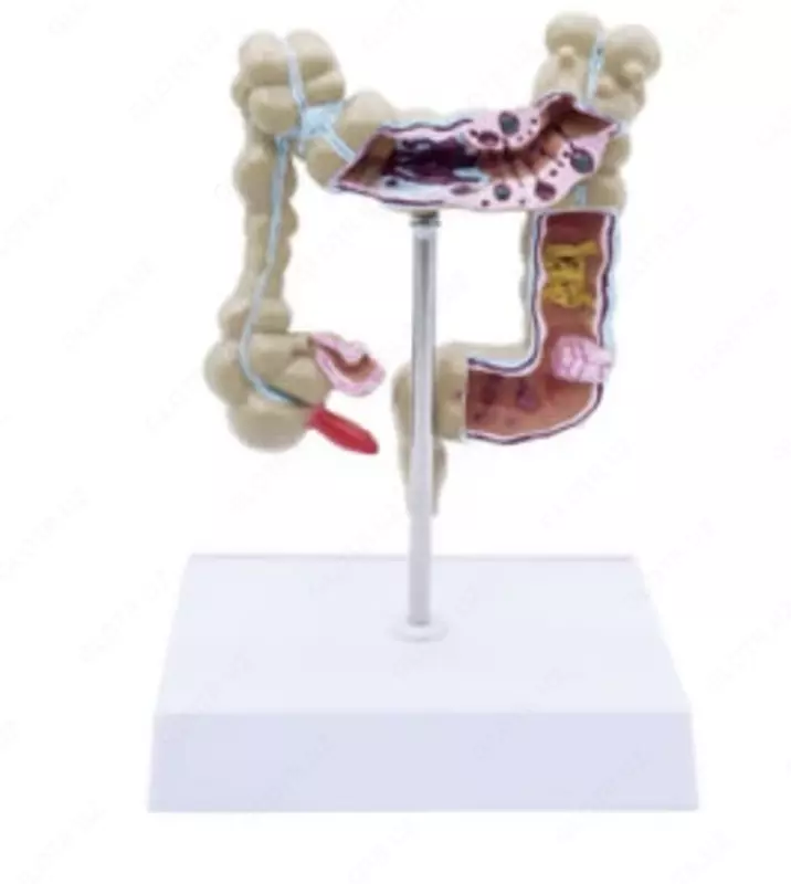 Анатомическая модель "патологии толстой кишки"